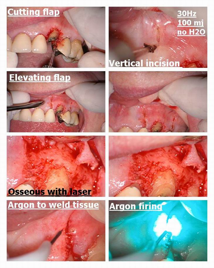 Resize of Osseous Recontouring on Canine pg 2.jpg